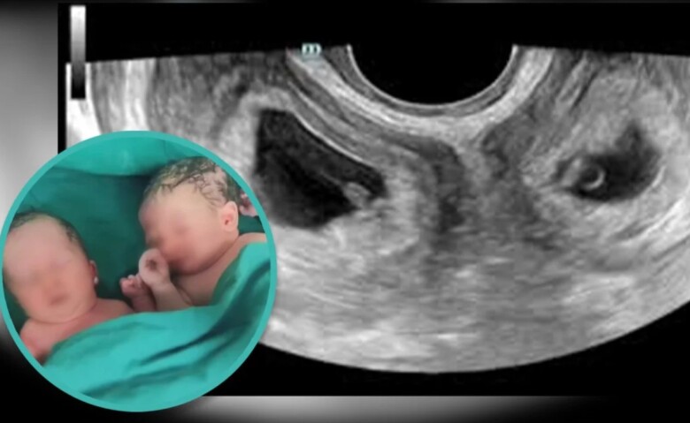 Cô Li đã sinh con thành công từ 2 tử cung riêng biệt.