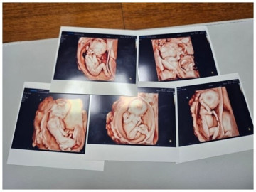 Người mẹ nhận thưởng hơn 3 tỷ đồng sau ca sinh 5 tự nhiên hiếm có