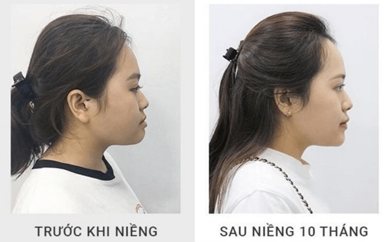 Niềng răng không chỉ giúp khắc phục các vấn đề về răng hô, móm, lệch lạc, mang đến một nụ cười tự tin và rạng rỡ mà còn góp phần cải thiện nhiều vấn đề khác.