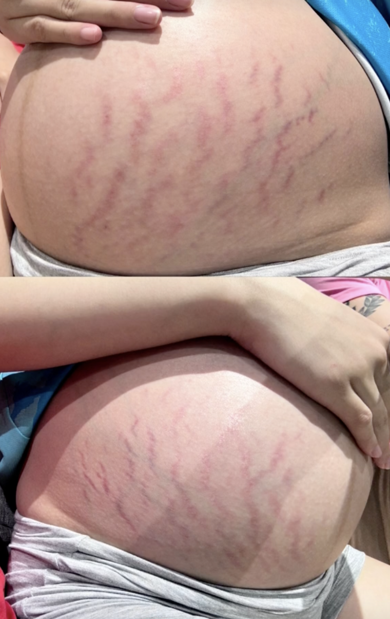 Lần đầu tiên Doãn Hải My công khai rõ ràng những vết rạn khi mang bầu.