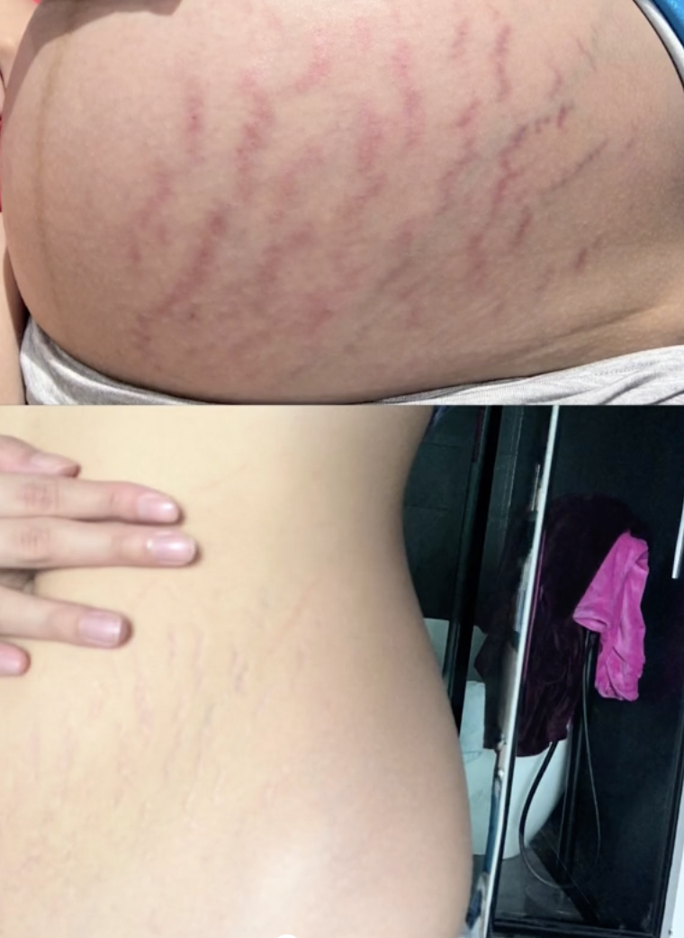 Hình ảnh so sánh bụng rạn khi mang thai và sau khi sinh của Doãn Hải My.
