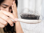 Sức khỏe - Mỗi ngày rụng cả nắm tóc là hiện tượng tự nhiên hay dấu hiệu bất thường?