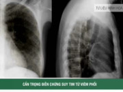 Clip Eva - Không chủ quan với bệnh viêm phổi dẫn đến biến chứng suy tim