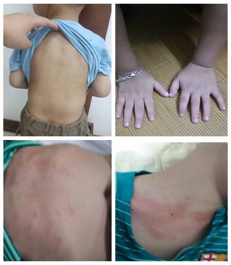 Hình ảnh những triệu chứng đau xương khớp và phát ban ngoài cơ của bé M trước khi đến khám và điều trị. Ảnh minh họa. 