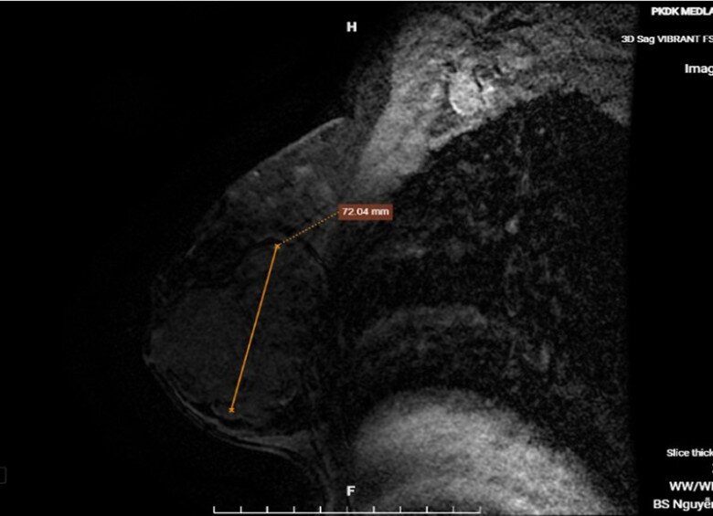 Kết quả chụp MRI vú cho hình ảnh khối u tuyến vú phải, bờ đa cung với đường kính lên tới 72mm. Ảnh: BSCC. 