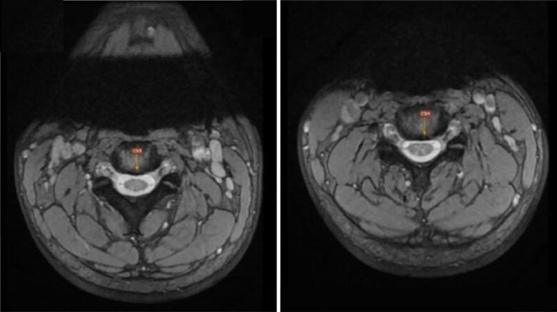 Hình ảnh chụp cộng hưởng từ cổ cho thấy bệnh nhân có thoái hóa đĩa đệm cột sống cổ. Ảnh: BSCC.