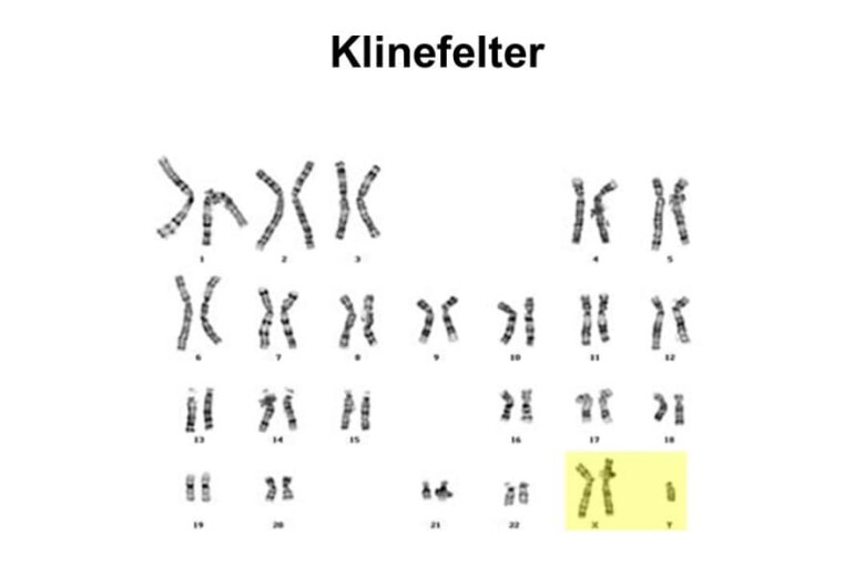 Khi mắc hội chứng Klinefelter sẽ ảnh hưởng rất lớn tới sức khỏe và là nguyên nhân vô sinh ở nam giới. Ảnh minh họa. 