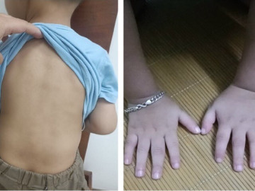 Bé trai 3 tuổi đã bị đau xương khớp, đi lại khom lưng như cụ già, đến viện bố mẹ bất ngờ khi biết nguyên nhân