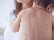 Sức khỏe - Nhiều phụ huynh "né" tiêm vaccine sởi vì sợ con suy yếu
