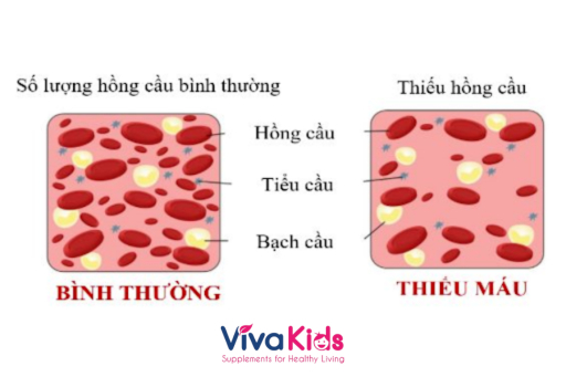 Tình trạng biếng ăn có mối liên hệ với nguy cơ thiếu sắt ở trẻ
