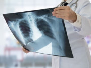 Sức khỏe - Người đàn ông 29 tuổi bất ngờ phát hiện ung thư phổi, thừa nhận có một sai lầm nhiều nam giới Việt mắc phải