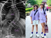 Yêu con - Con gái siêu mẫu Thuý Hằng gặp tai nạn biến dạng cột sống, sau phẫu thuật ngoại hình thay đổi bất ngờ, cao thêm 7cm