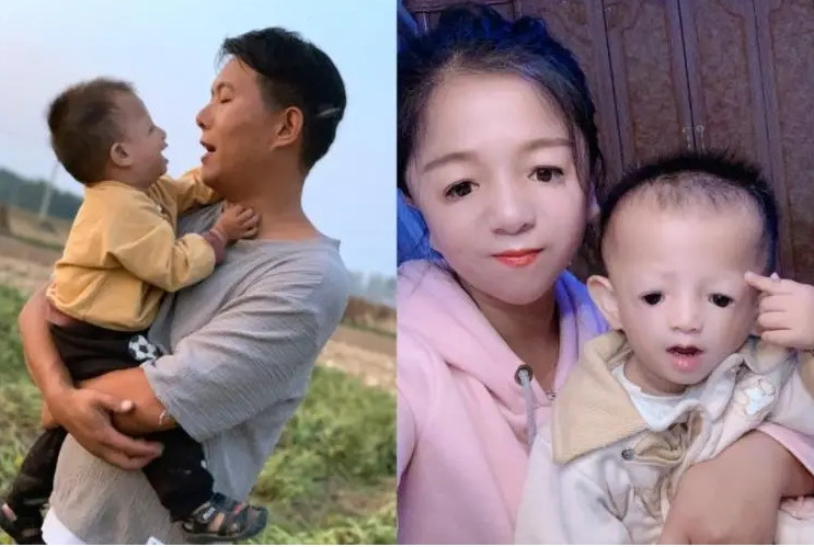 Con trai thứ 2 mắc hội chứng mặt chim giống mẹ. Ảnh: Sohu
