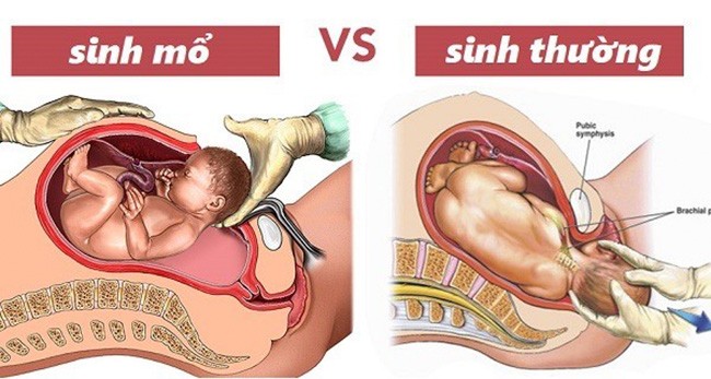 Các chuyên gia y tế cảnh báo sinh mổ, nhất là chọn ngày giờ đẹp để mổ tiềm ẩn nhiều rủi ro hơn so với sinh thường. Ảnh minh họa