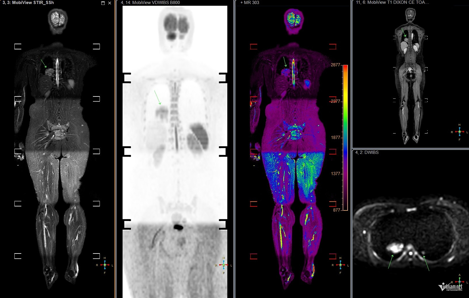 Hình ảnh MRI toàn thân của bệnh nhân ung thư phổi. Ảnh: Minh Đức.