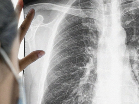 Người vợ mắc ung thư giai đoạn cuối do thói quen của chồng