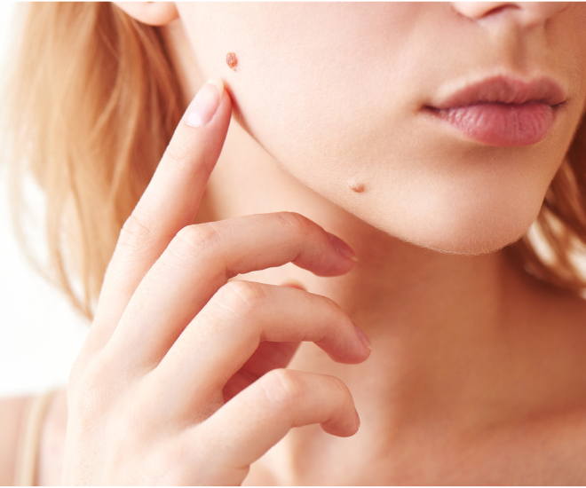 Nốt ruồi là một phần rất phổ biến trên da, nhưng một số loại nốt ruồi có thể là dấu hiệu của u hắc tố.  (Ảnh minh hoạ).