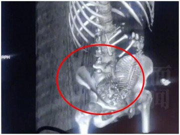 Phủ nhận mang thai đến phút chót, cô gái 19 tuổi khiến cả ê-kíp y tế "đứng hình" khi chụp CT