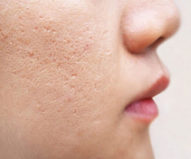 Lỗ chân lông to là vấn đề nan giải của chị em.