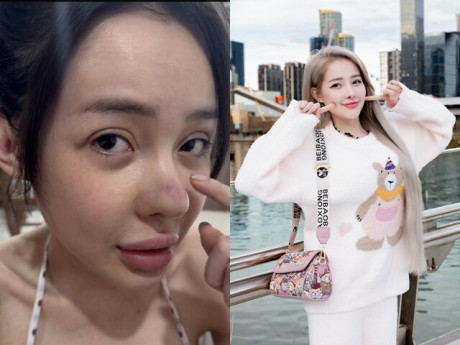 Sau 12 lần phẫu thuật thẩm mỹ rồi bị co rút mũi, Ngân 98 lại tiếp tục "gặp biến" khiến dân tình tá hoả