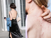 Đẹp - 5 thói quen tưởng vô hại khiến mụn lưng mọc dày, trị mãi không hết, chỉ thay đổi 1 bước khi gội đầu có thể cải thiện rất nhiều