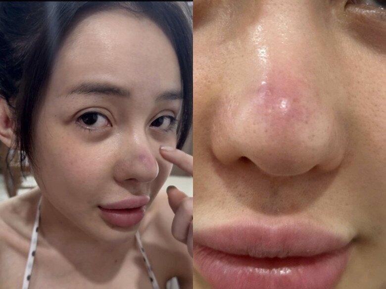 Ngân 98 cho biết ban đầu chỉ nghĩ mọc mụn trên mũi nhưng kết quả đi khám, bác sĩ bảo mũi của cô bị viêm cần điều trị đề phòng biến chứng.