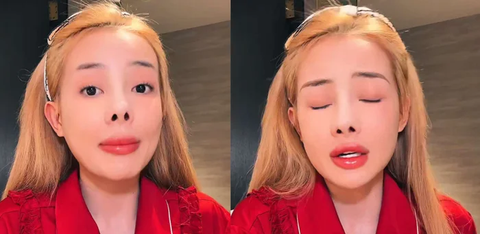 Sau ca thẩm mỹ ở Hàn Quốc 2 tháng, Ngân 98 buồn bã nói rằng đầu mũi cô bị hếch, lệch và co rút sau lần dao kéo mới nhất. 