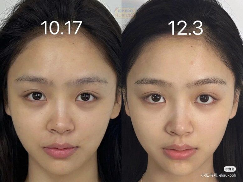 Chỉ sau hơn 1 tháng, da mặt của cô gái này đã có sự biến chuyển, quầng thâm cũng mờ dần.