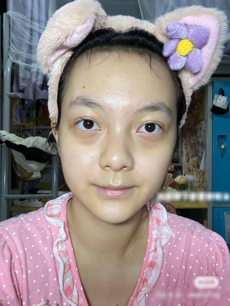 Tình trạng da của cô sinh viên trước khi cải tạo trông khá tối màu, đặc biệt là phần quầng thâm 2 bên mí mắt rất rõ và đậm màu. 