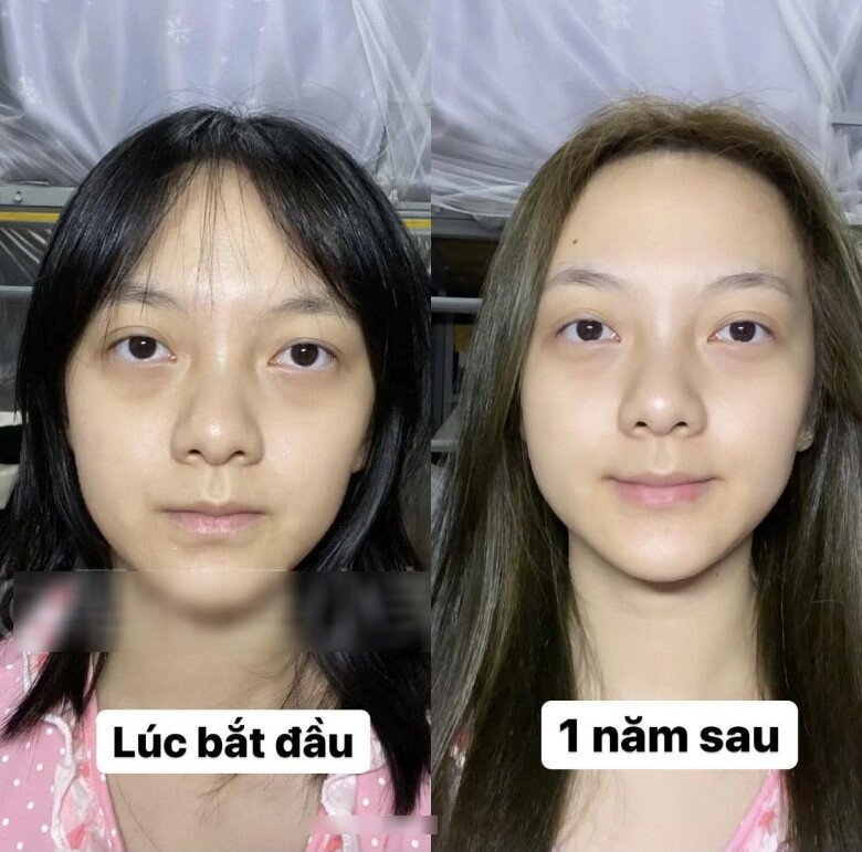 Sau 1 năm kiên trì đi ngủ sớm, làn da của cô đã trắng hơn, trông mịn màng và căng bóng, riêng phần quầng thâm mắt rõ rệt ngày xưa đã biến mất gần như 90%.