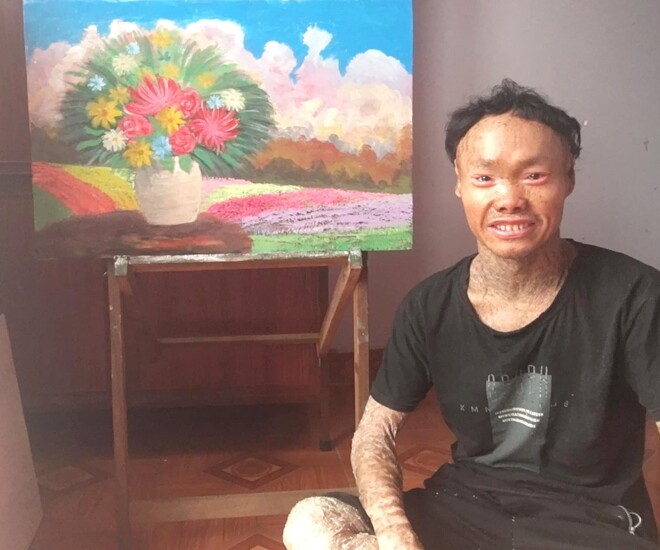 Anh Thọ mắc căn bệnh da khô vảy cá bẩm sinh