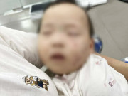 Tin tức - Xác minh vụ bé gái có nhiều vết bầm trên mặt khi gửi ở cơ sở mầm non
