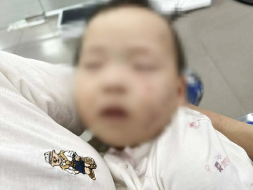 Xác minh vụ bé gái có nhiều vết bầm trên mặt khi gửi ở cơ sở mầm non