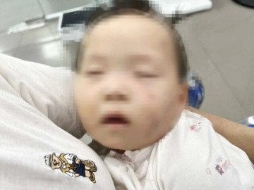 Tạm giữ nữ giáo viên trong vụ bé gái có nhiều vết bầm tím chi chít trên mặt