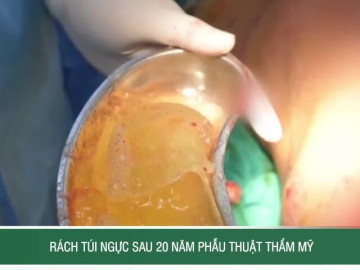 Rách túi ngực sau 20 năm phẫu thuật thẩm mỹ