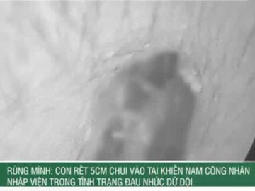 Rùng mình: Con rết 5cm chui vào tai khiến nam công nhân nhập viện trong tình trạng đau nhức dữ dội