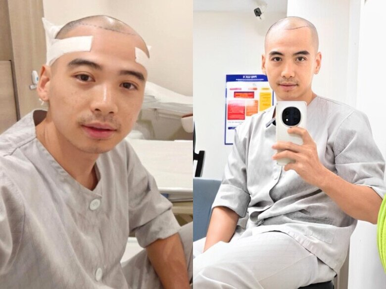Ông xã H’Hen Niê chịu đau để đi cấy tóc.