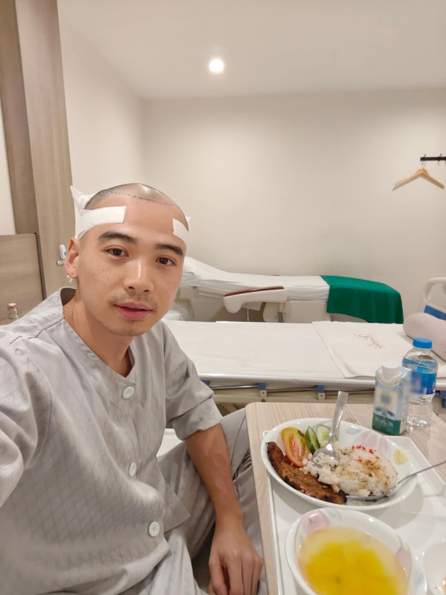 Tuấn Khôi tiết lộ hình ảnh khi đi cấy tóc để cải thiện ngoại hình.