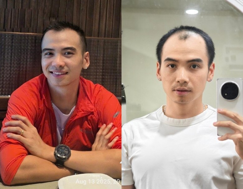 Sau mọc tóc, diện mạo chồng nàng hậu ngày càng điển trai và nam tính hơn.