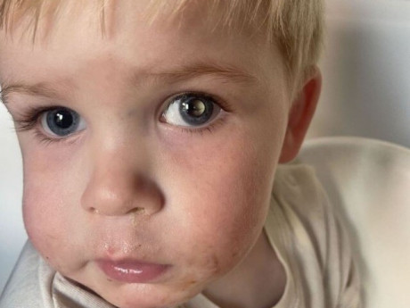 Cô giáo gửi ảnh con trai ở trường, mẹ bỗng phát hiện mắt con 2 màu, đưa vào bệnh viện bác sĩ bắt phẫu thuật gấp