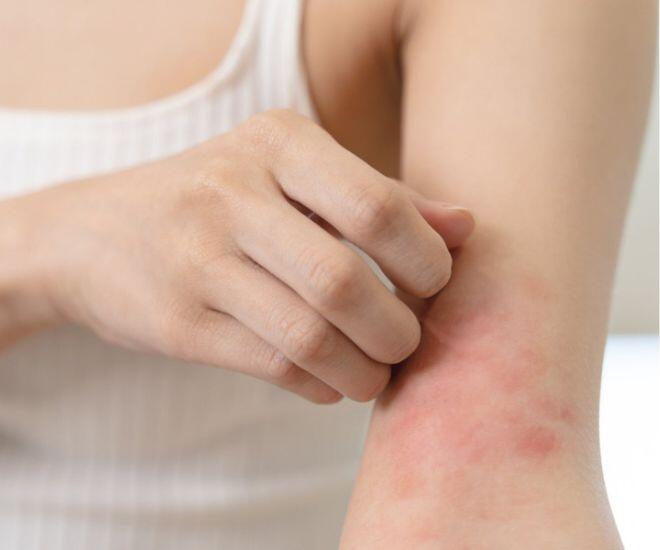  Cảm giác mẩn ngứa toàn thân gây khó chịu cho người bệnh (Ảnh minh hoạ)