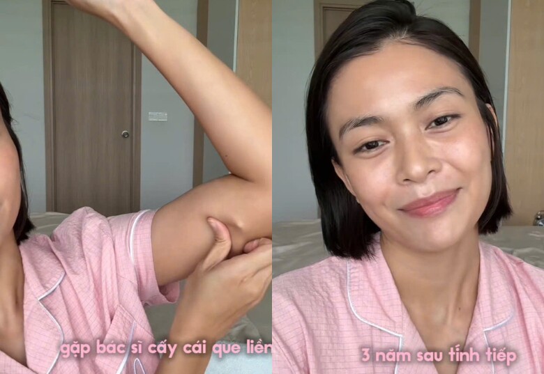 Á hậu 9X chia sẻ về quyết định cấy que tránh thai.