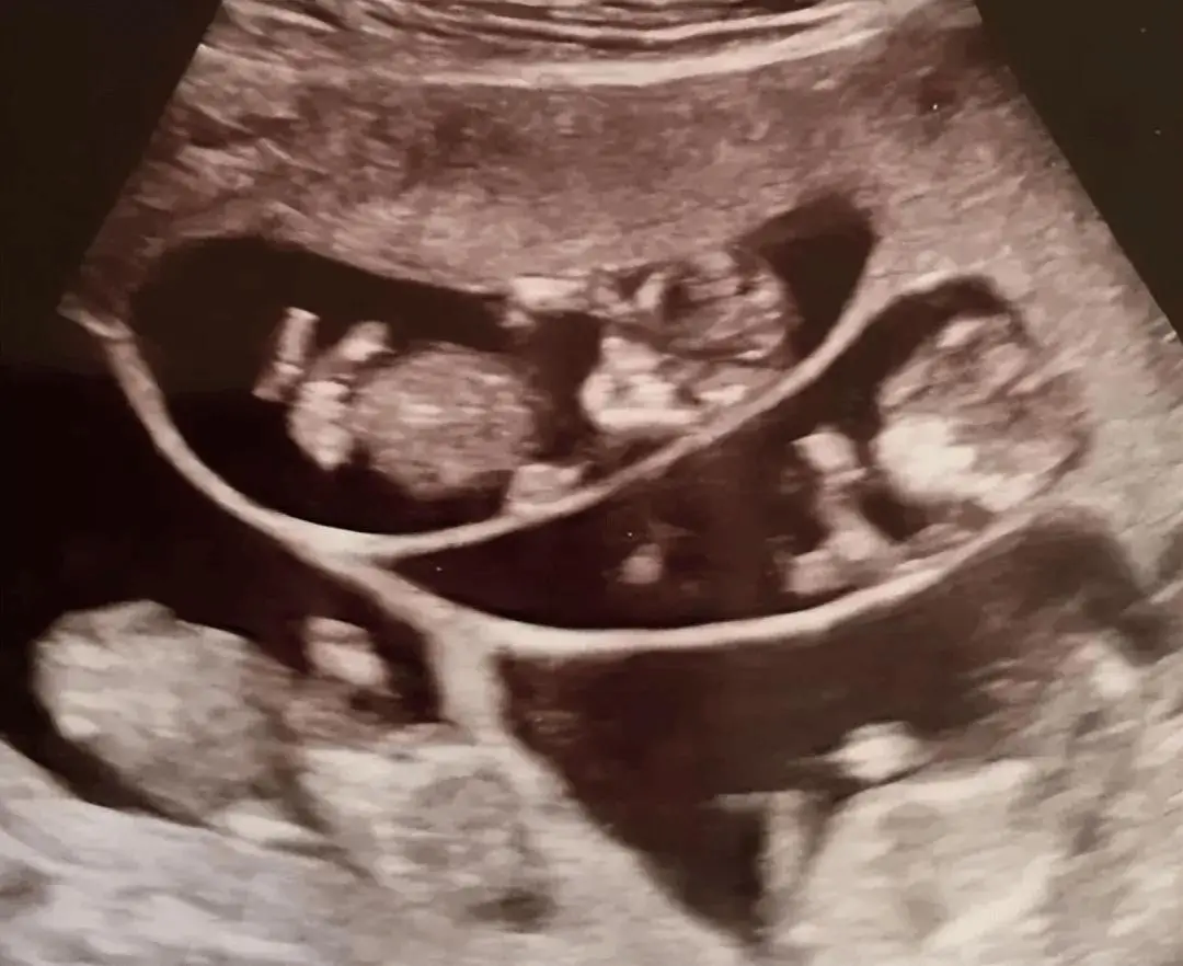 Bà mẹ trẻ mang bầu đa thai sau thời gian tìm con bằng thủ thuật hỗ trợ sinh sản.