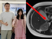 Bà bầu - Cơ thể bà bầu đột nhiên chuyển vàng phải đi cấp cứu, bác sĩ phát hiện 2 “vật thể lạ” trong ổ bụng, phải phẫu thuật để giữ mạng sống
