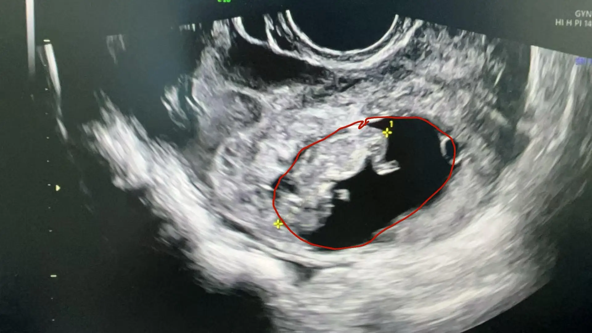 Ảnh chụp bào thai trong ổ bụng của cô Cốc.