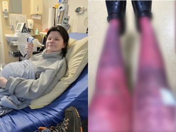 Cơ thể sản phụ phồng rộp, phải ngồi xe lăn sau sinh vì mắc bệnh hiếm, phản ứng của bác sĩ khiến cả nhà bất bình