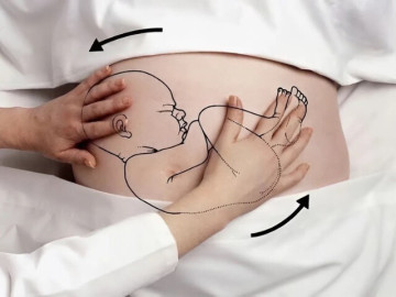 Từ chuyện một hoa hậu Việt nhờ bà đỡ xoay ngôi thai và góc nhìn y khoa: Hiểu đúng vì sự an toàn của mẹ và bé