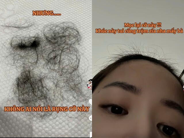 Puka rụng tóc cả mảng sau khi sinh con.