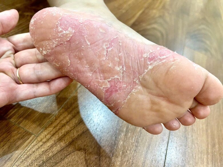 Rất nhiều người bị tổn thương nặng vì tiếp xúc với nước lũ bị ô nhiễm. Ảnh: BSCC.