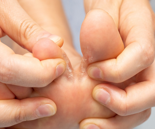 Khi lội nước, nhất là nước bị ô nhiễm nguy cơ mắc bệnh da liễu như nấm kẽ chân là rất lớn. Ảnh minh họa. 